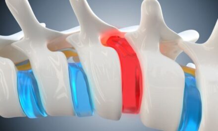 Hernia diskale: Simptomat dhe trajtimi