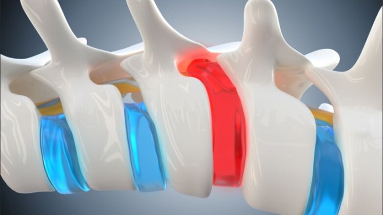 Hernia diskale: Simptomat dhe trajtimi